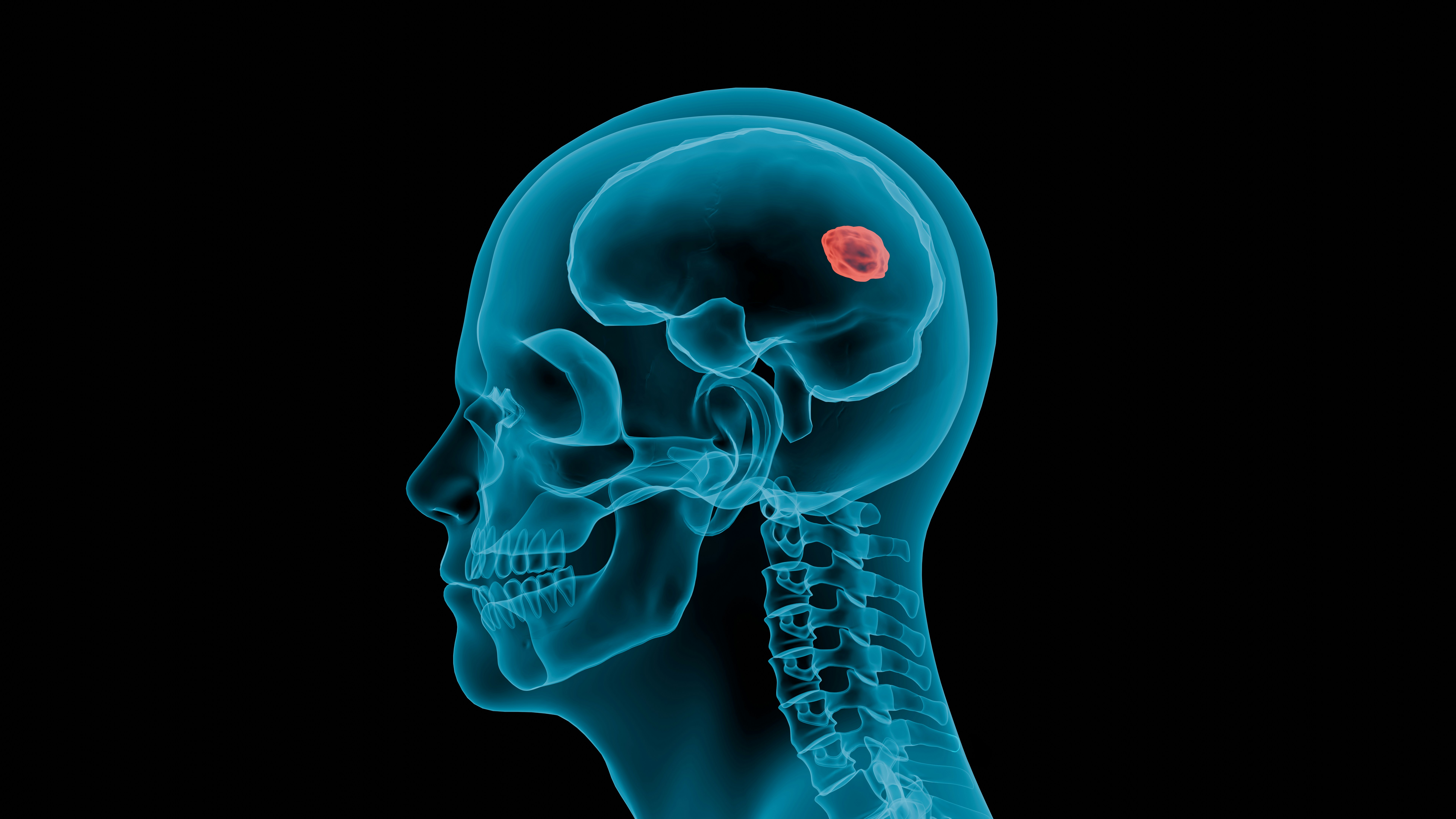 An image of brain tumor